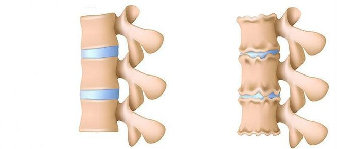 Ce este osteochondroza