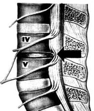 X -RAY Imaginea departamentului de osteocondroză lombară