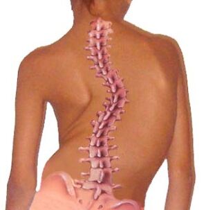 Curbura coloanei vertebrale duce la osteocondroză