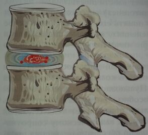 Prima etapă a osteocondrozei