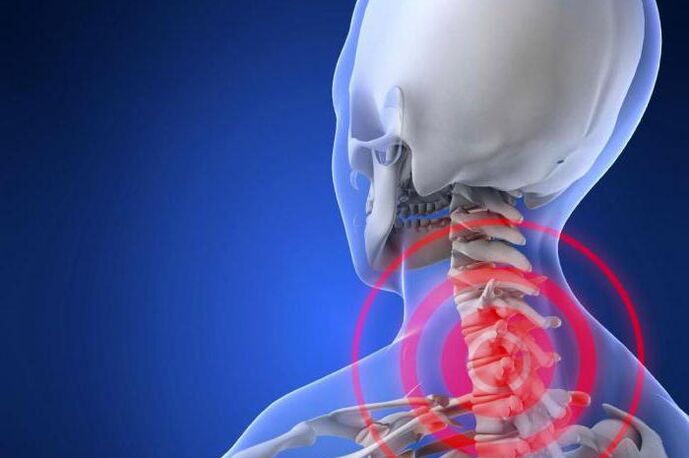Durerea fulgerătoare în gât este un simptom precoce al osteocondrozei cervicale